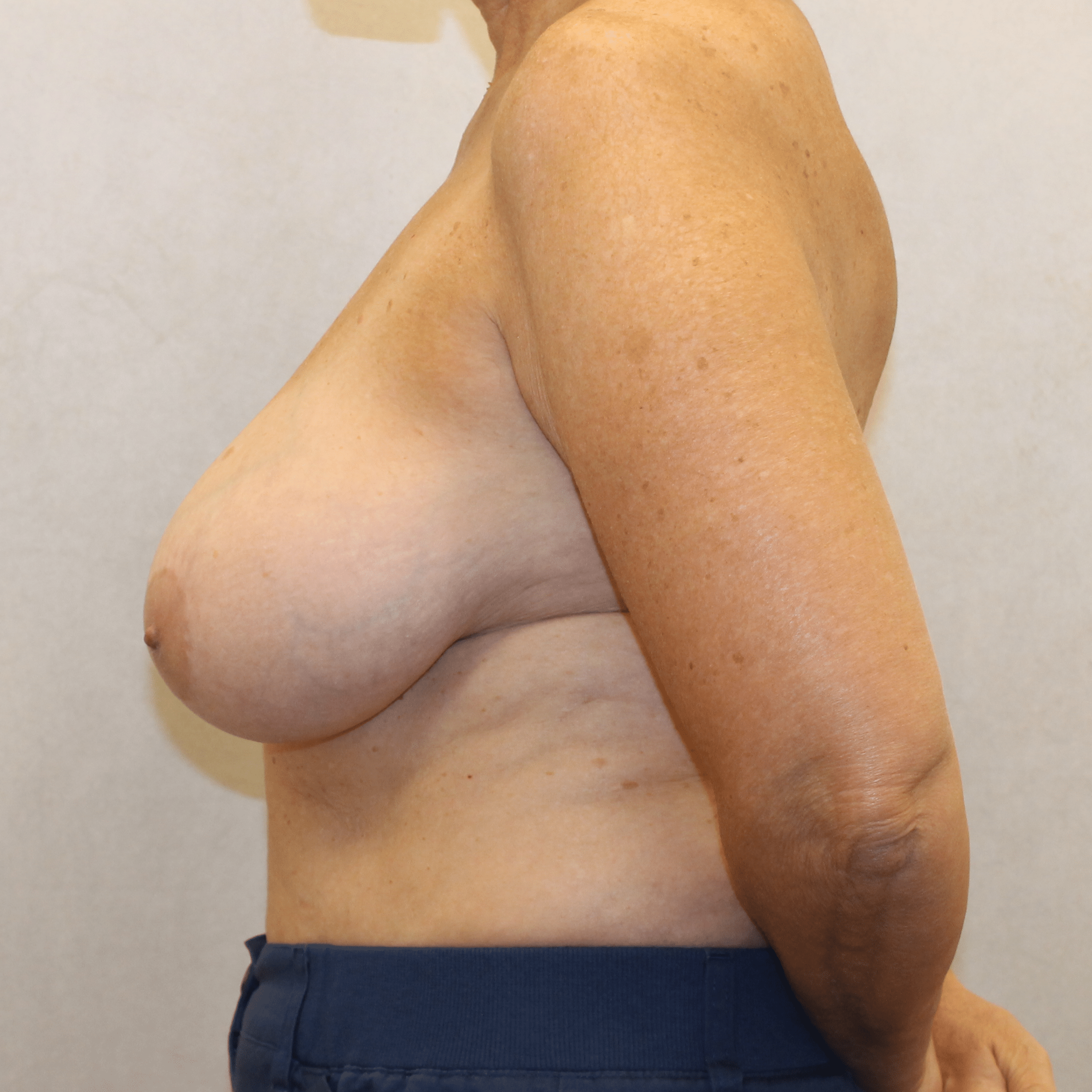Before Image:  - left-side