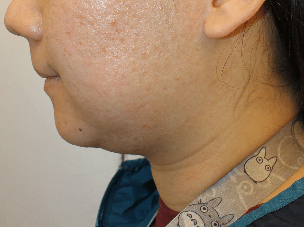 Before Image:  - left-side