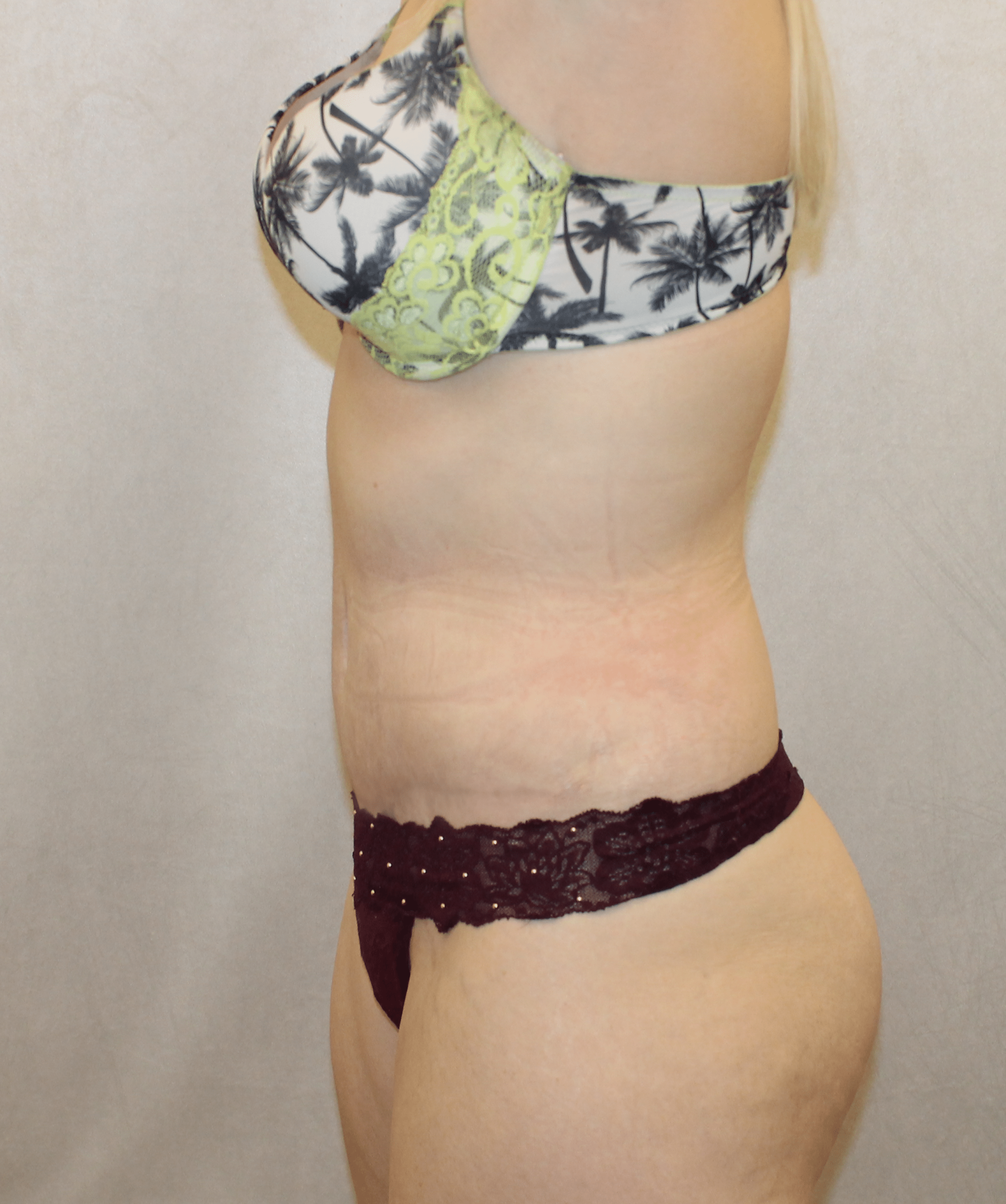 After Image:  - left-side