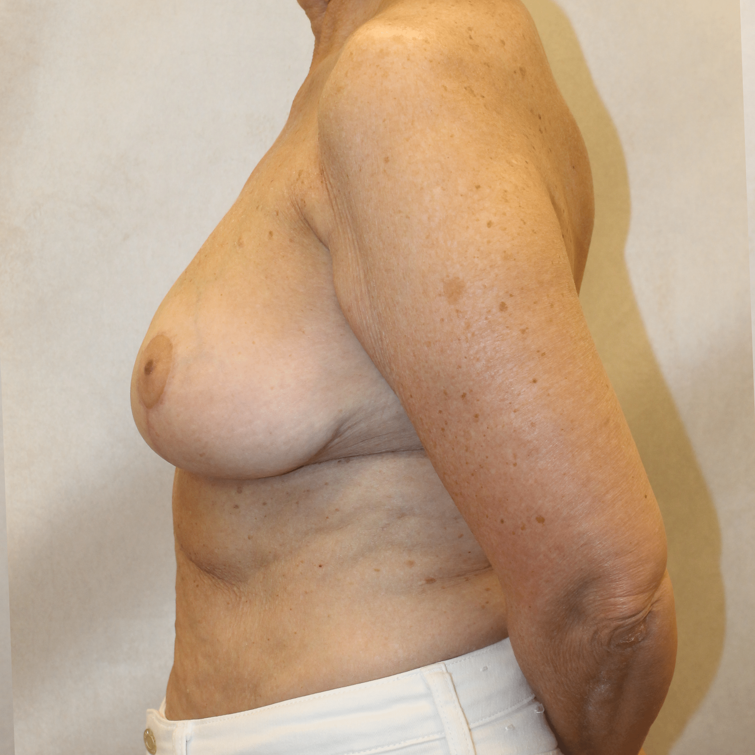 After Image:  - left-side