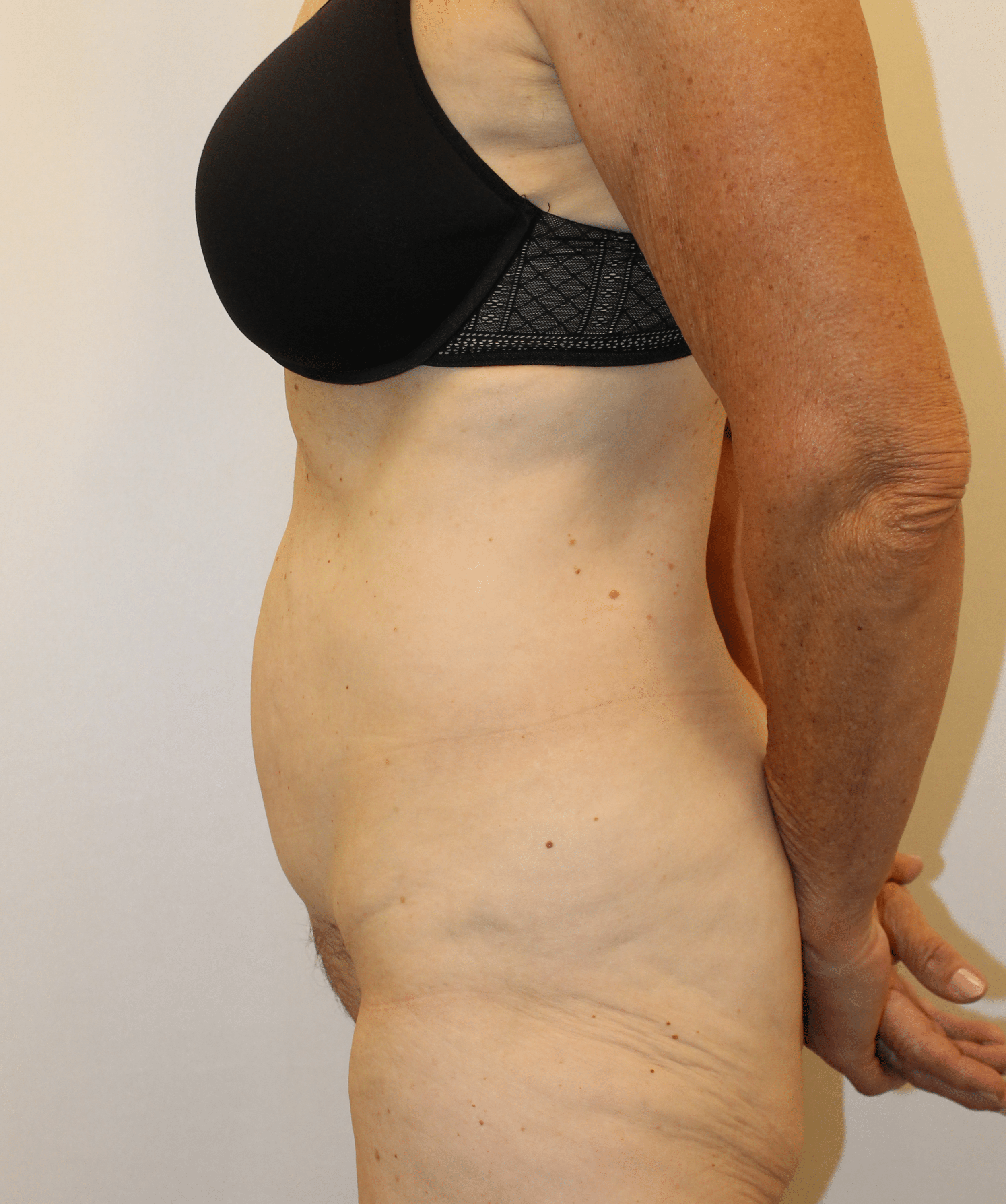 After Image:  - left-side