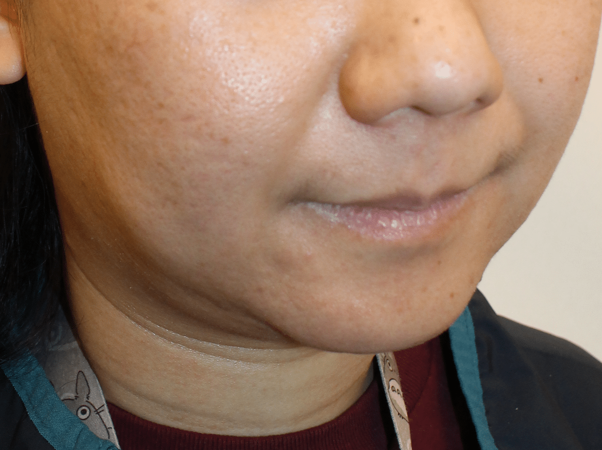 Before Image:  - right-front-oblique