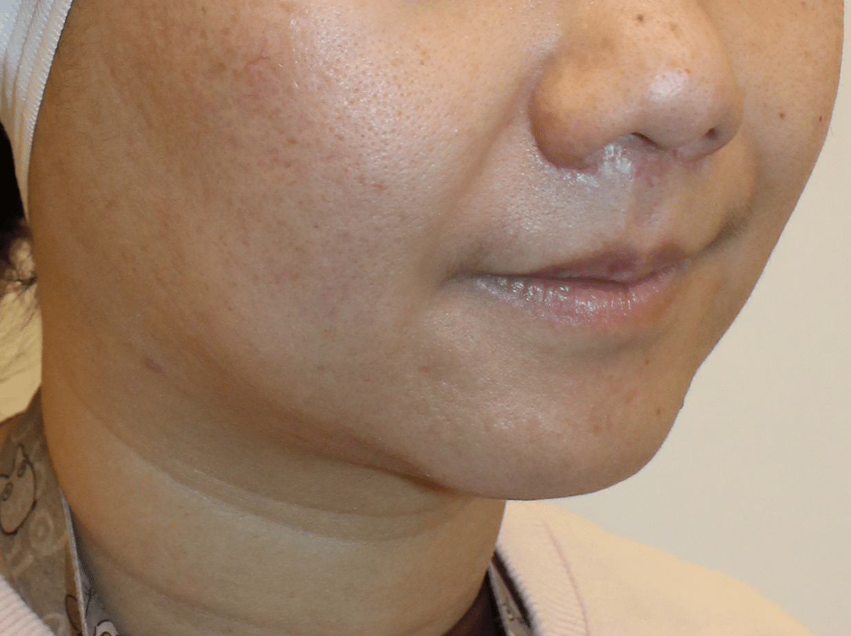 After Image:  - right-front-oblique