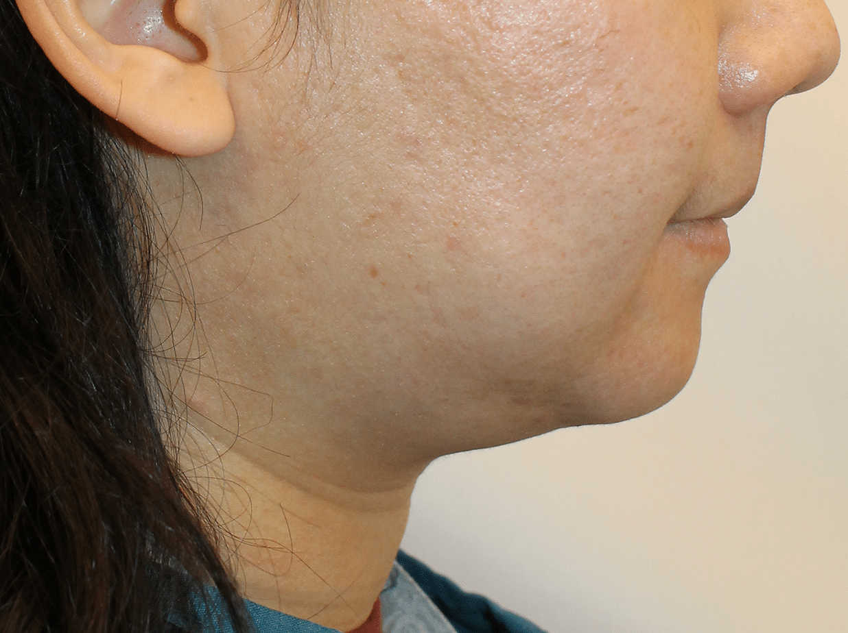 Before Image:  - right-side