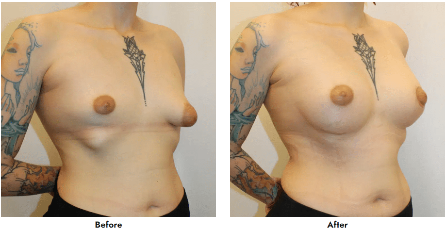 tuberous-breast-breast-asymmetry