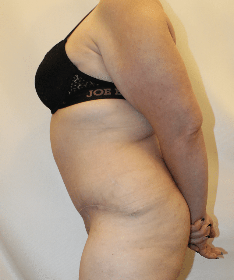After Image:  - left-side