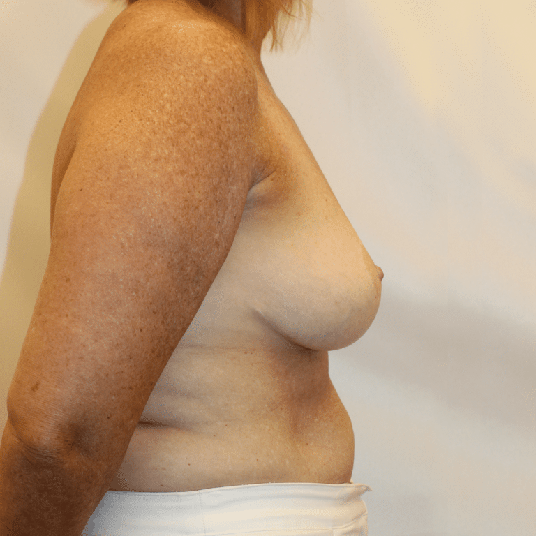 After Image:  - right-side