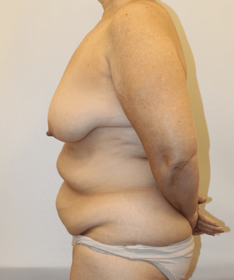 Before Image:  - left-side