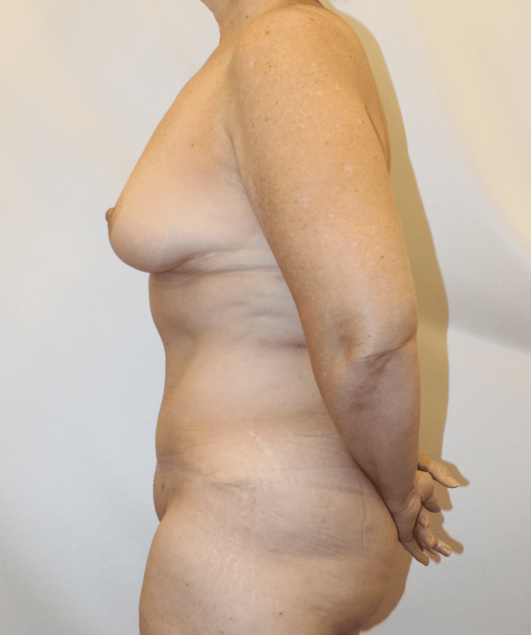 After Image:  - left-side