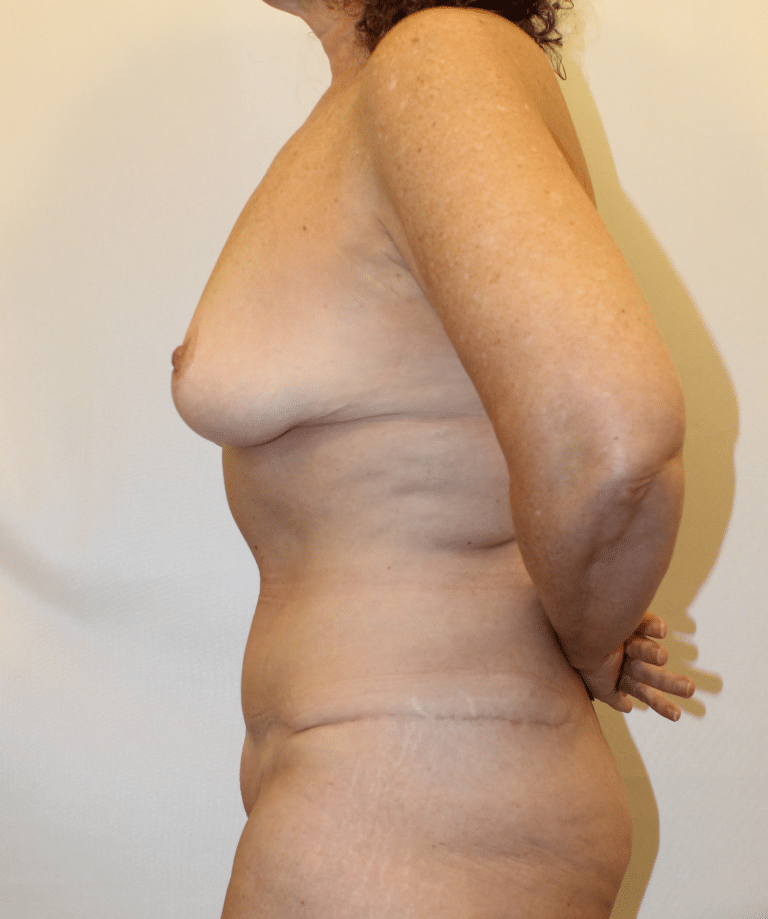 After Image:  - left-side