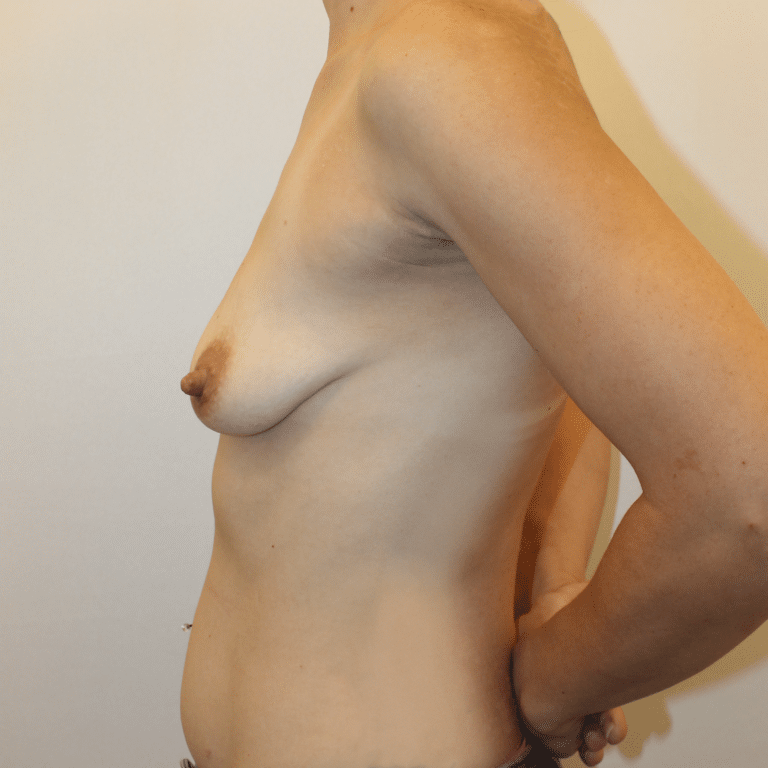 Before Image:  - left-side
