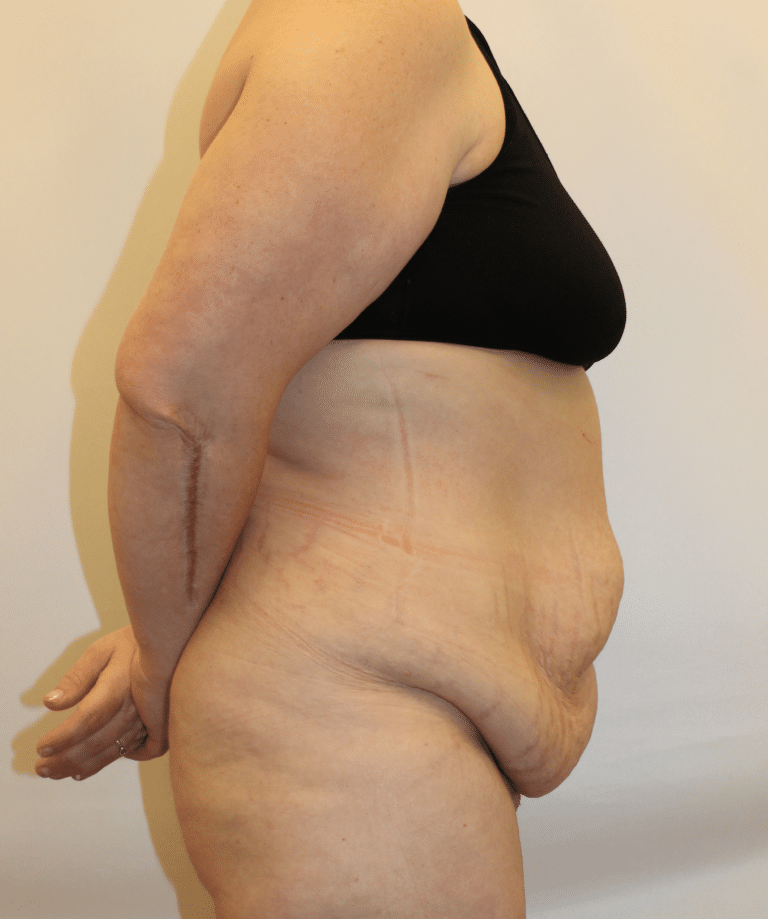 Before Image:  - right-side