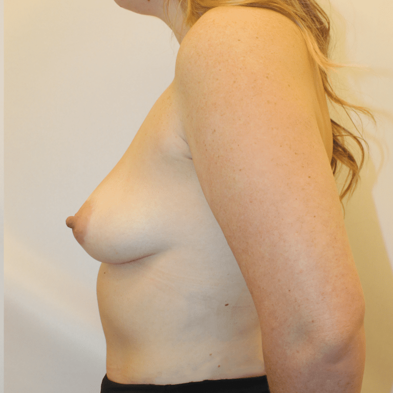 Before Image:  - left-side
