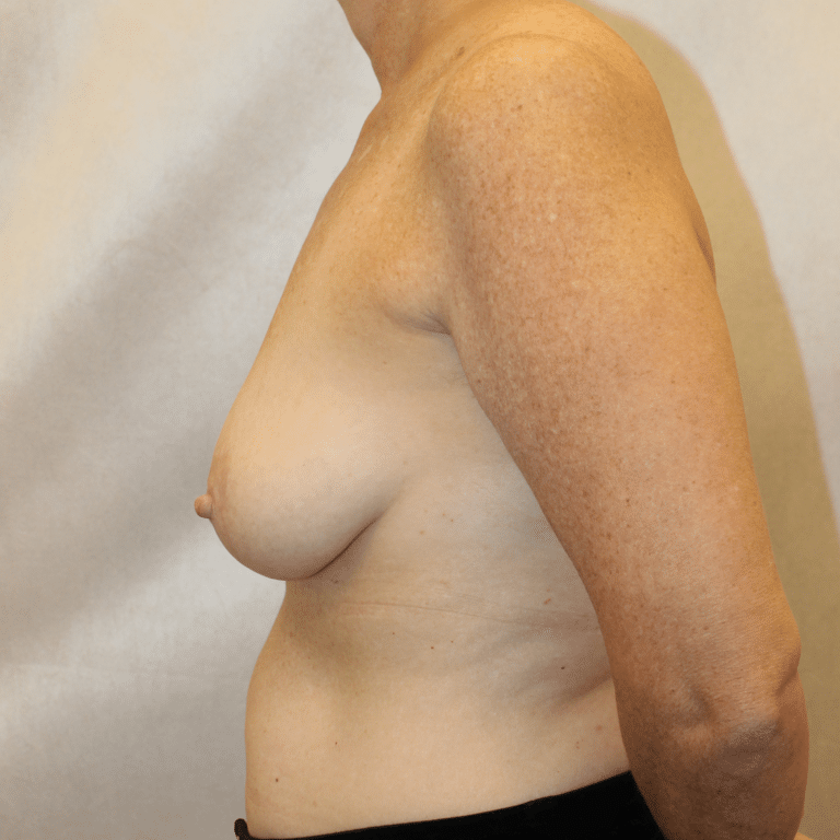 Before Image:  - left-side