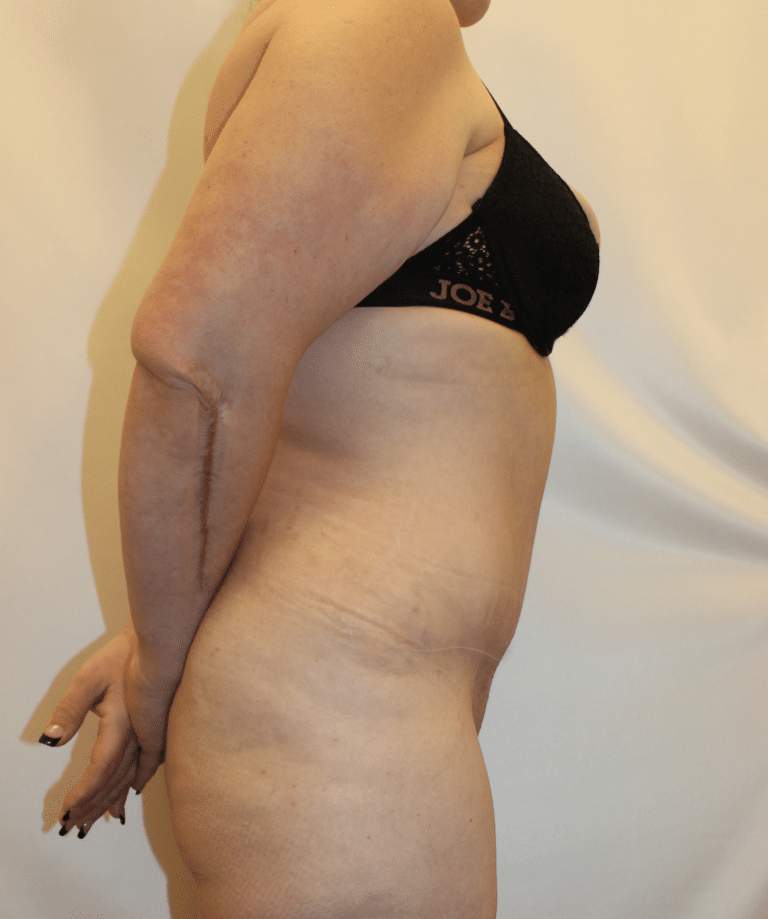 After Image:  - right-side