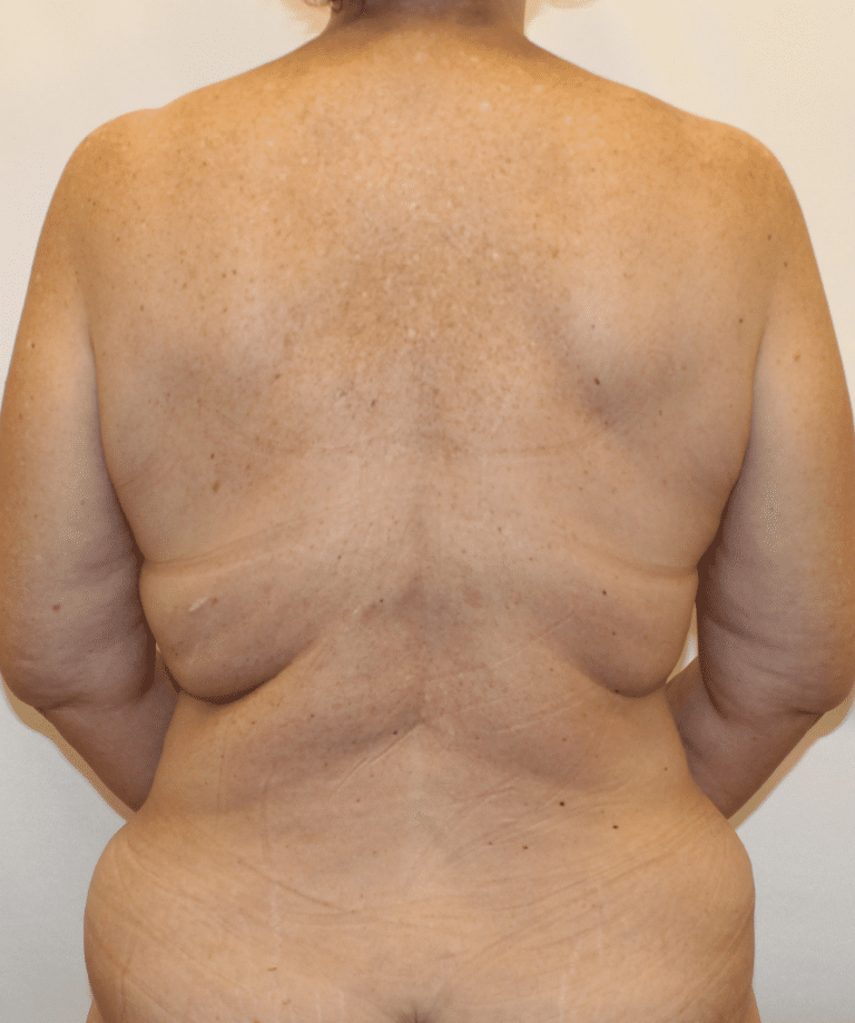 After Image:  - front
