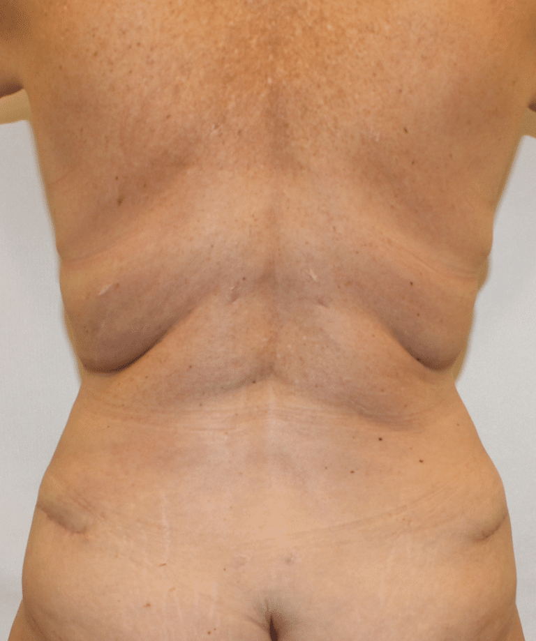After Image:  - front