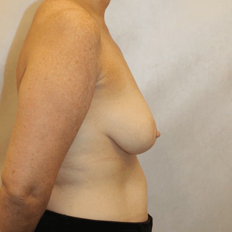 Before Image:  - right-side