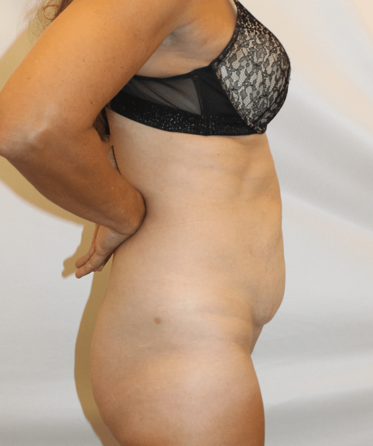 Before Image:  - right-side
