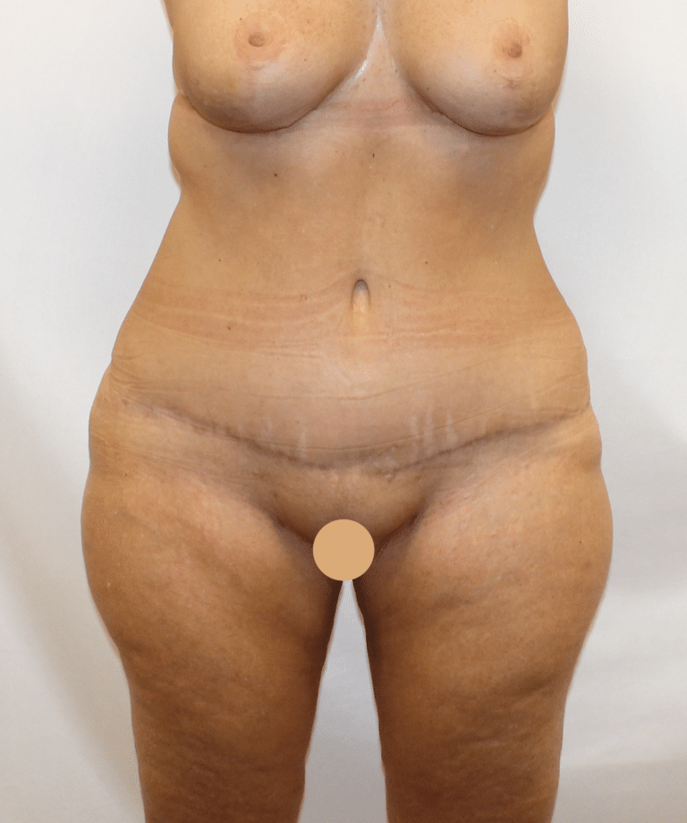 After Image:  - front