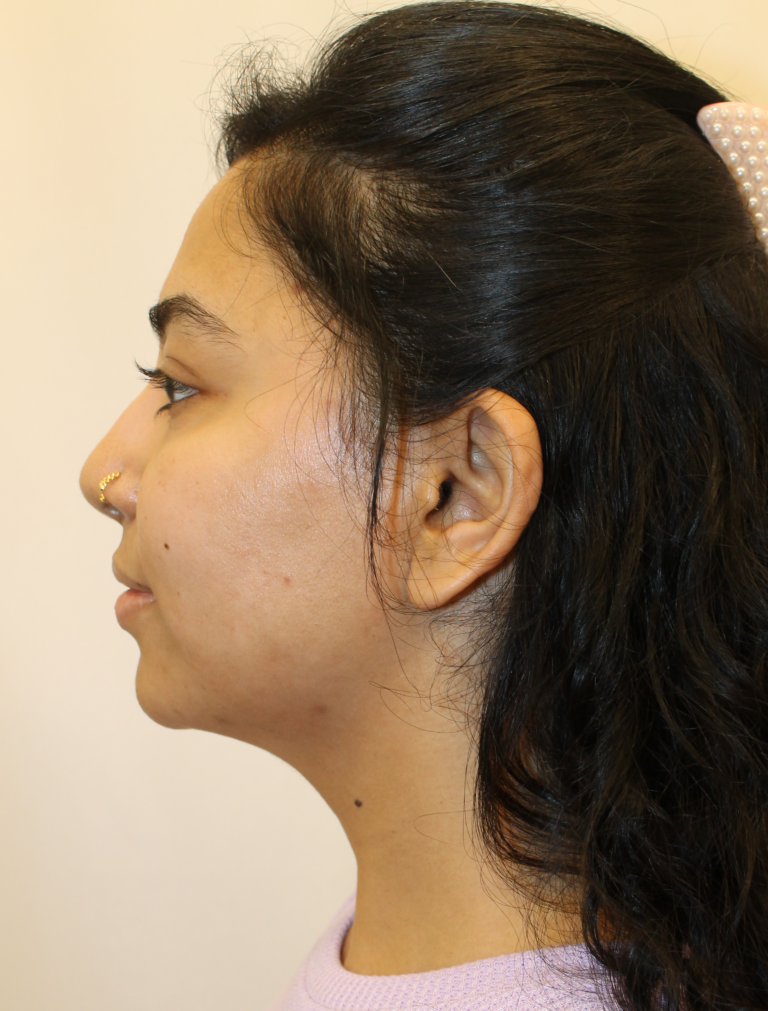 Before Image:  - left-side