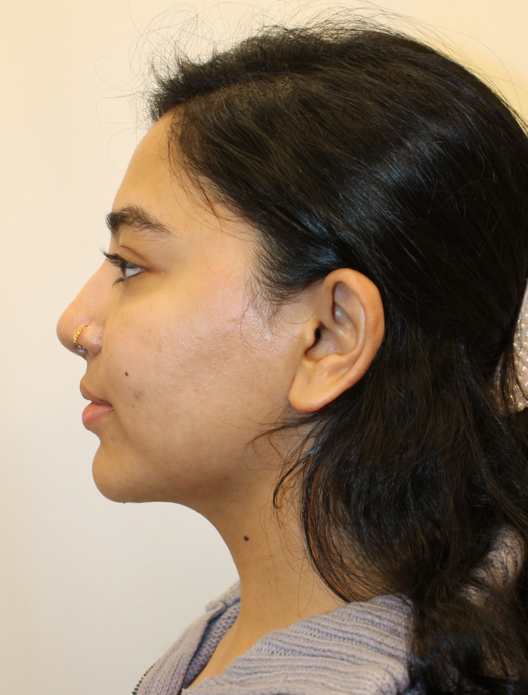 After Image:  - left-side