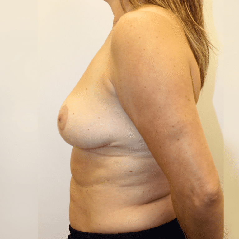 After Image:  - left-side