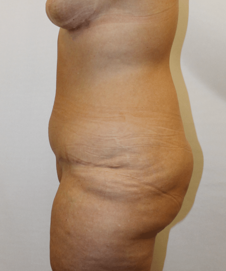 After Image:  - left-side