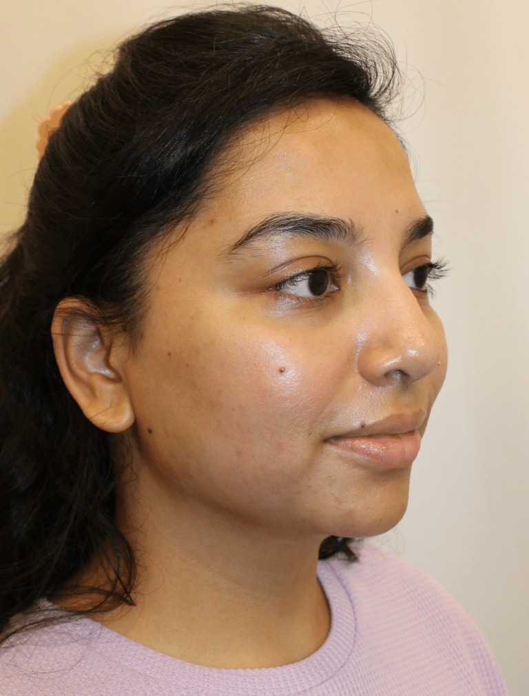 Before Image:  - right-front-oblique