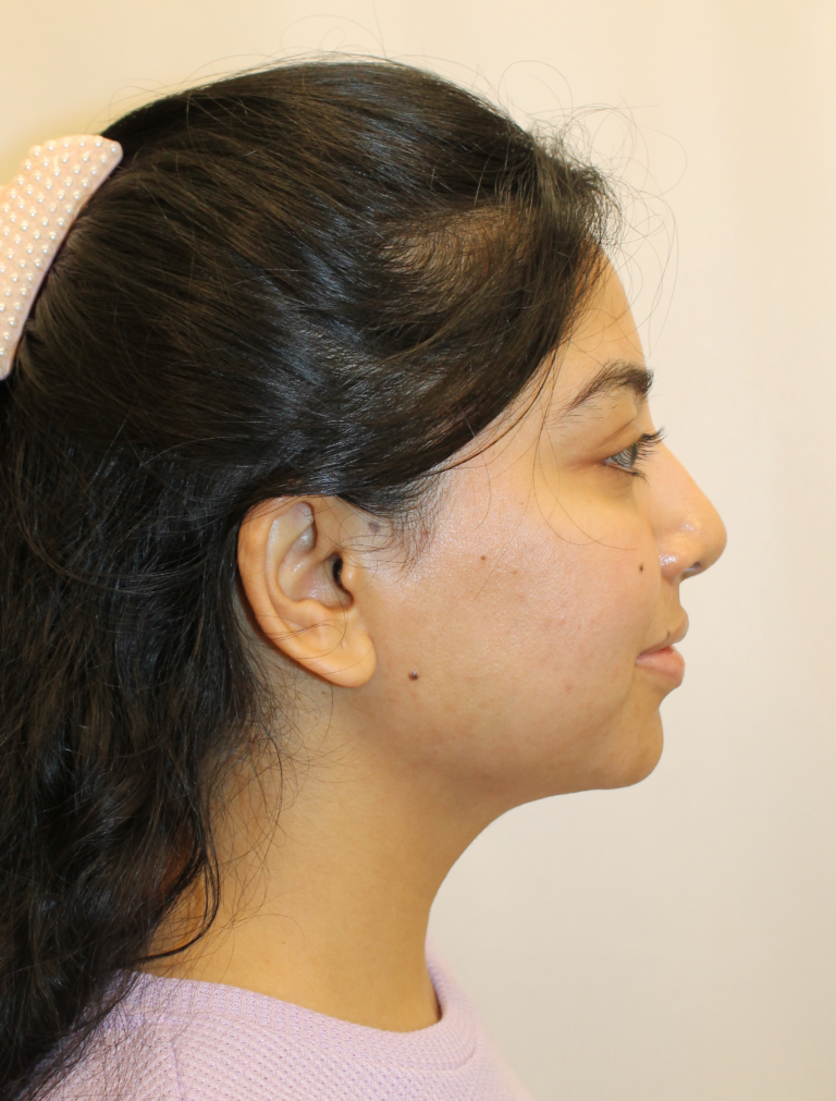 Before Image:  - right-side