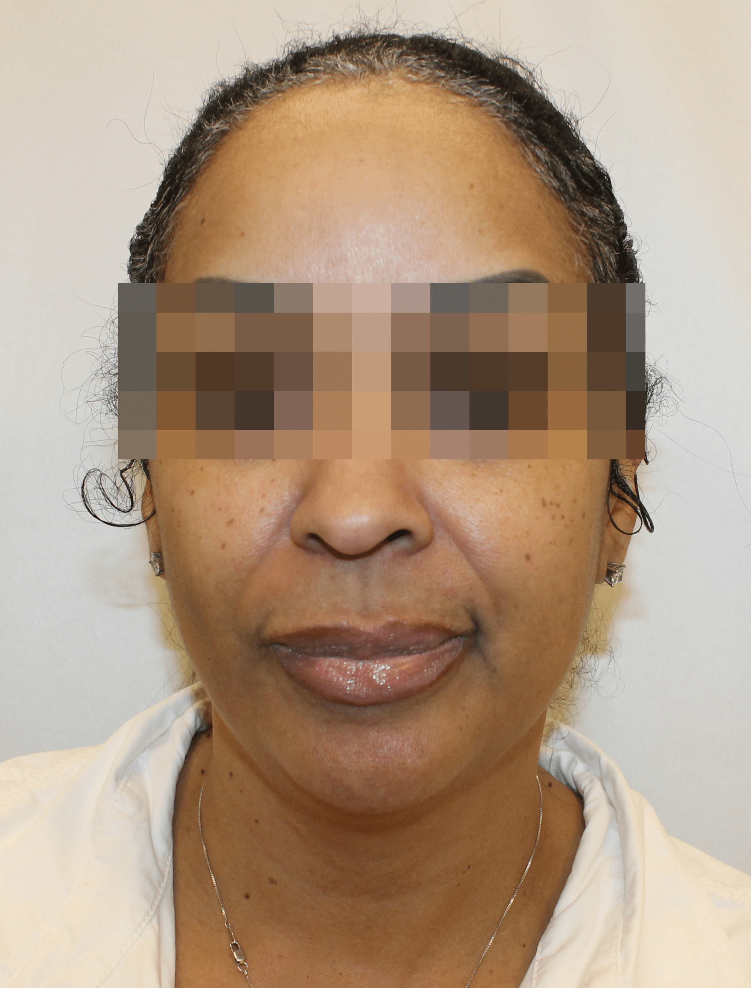 Before Image:  - front