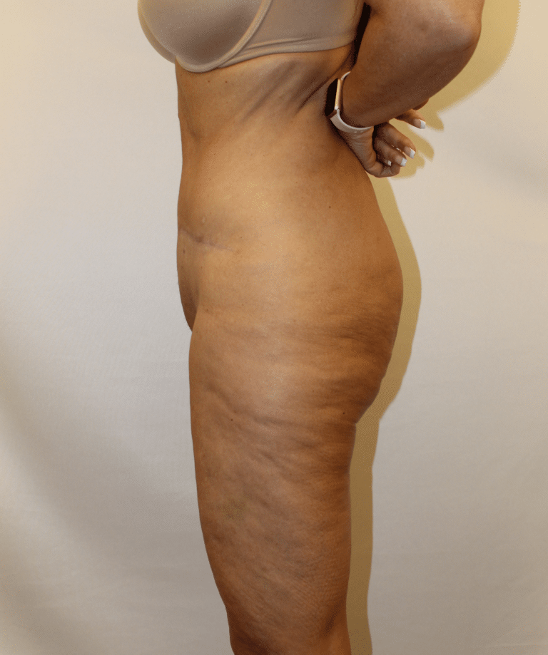 After Image:  - left-side