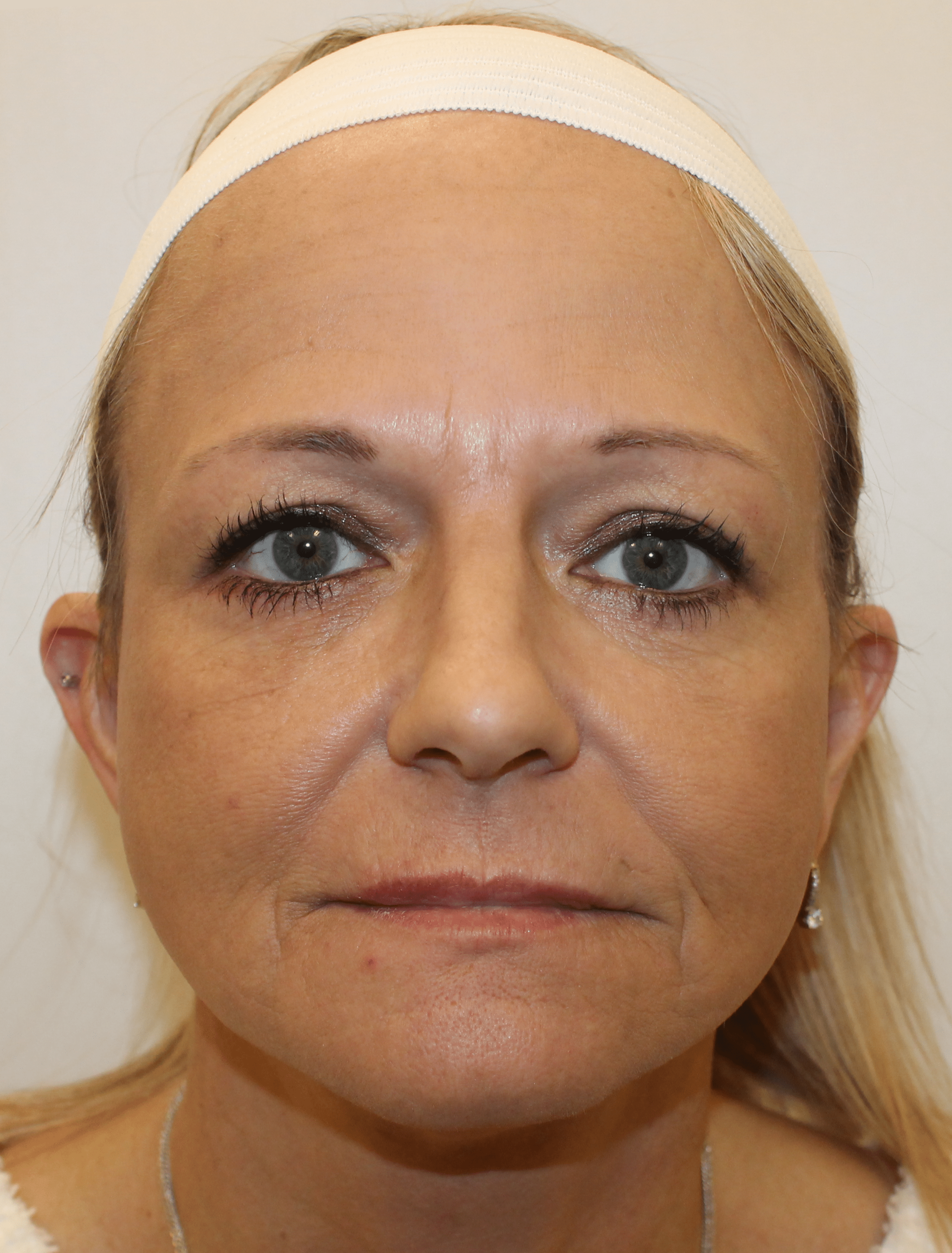 After Image:  - front