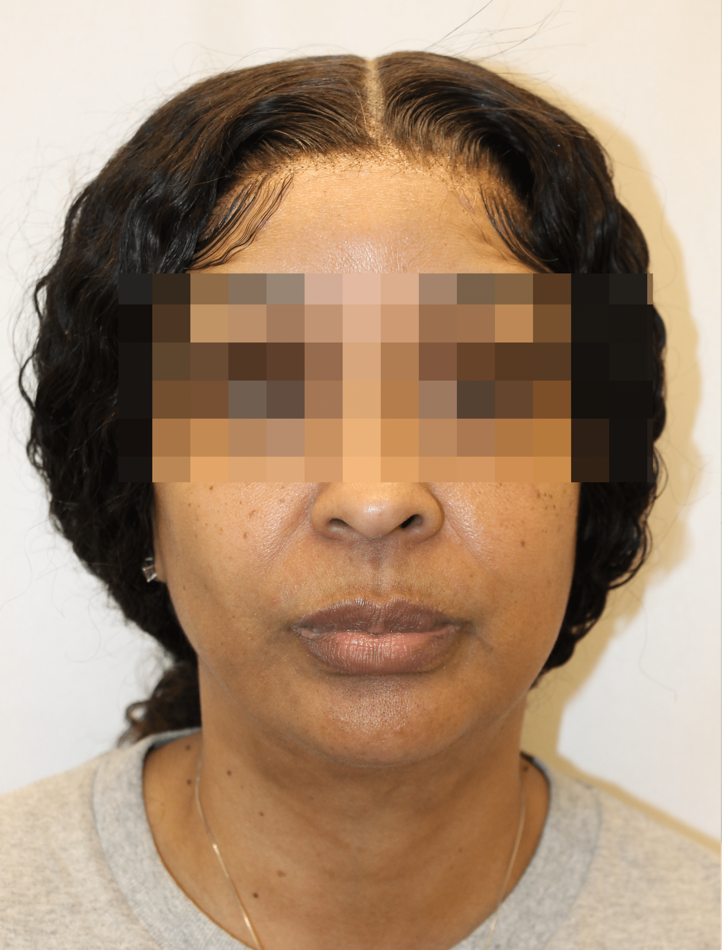 After Image:  - front