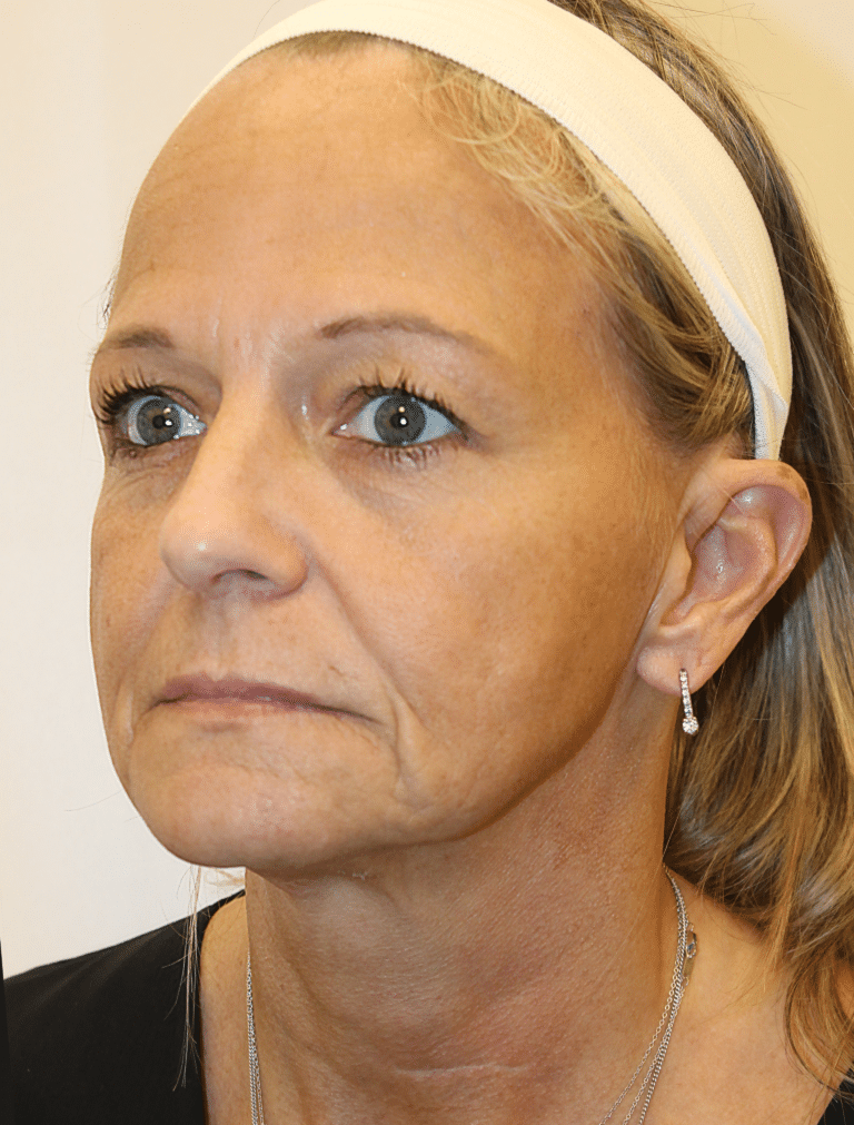 Before Image:  - left-front-oblique