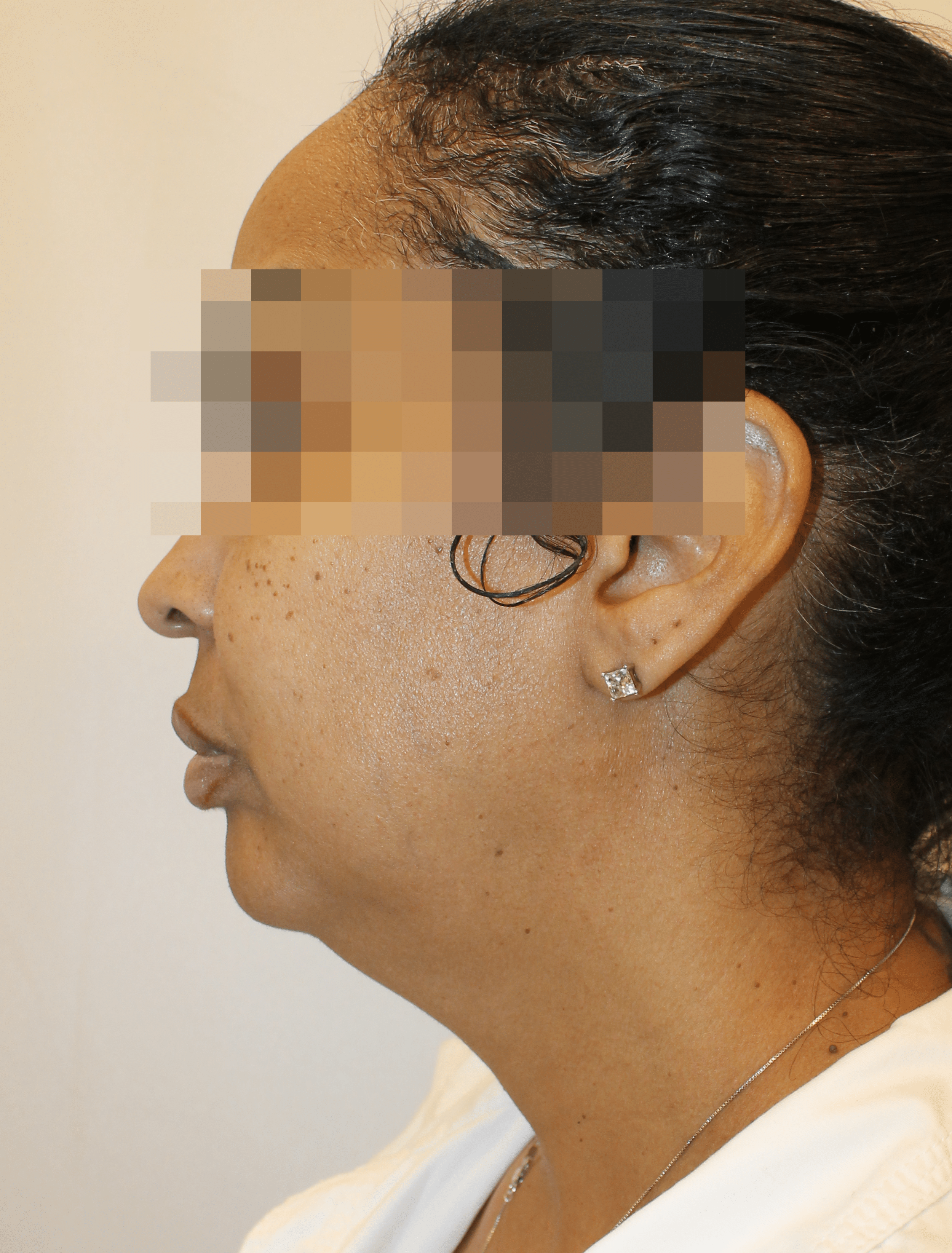 Before Image:  - left-side