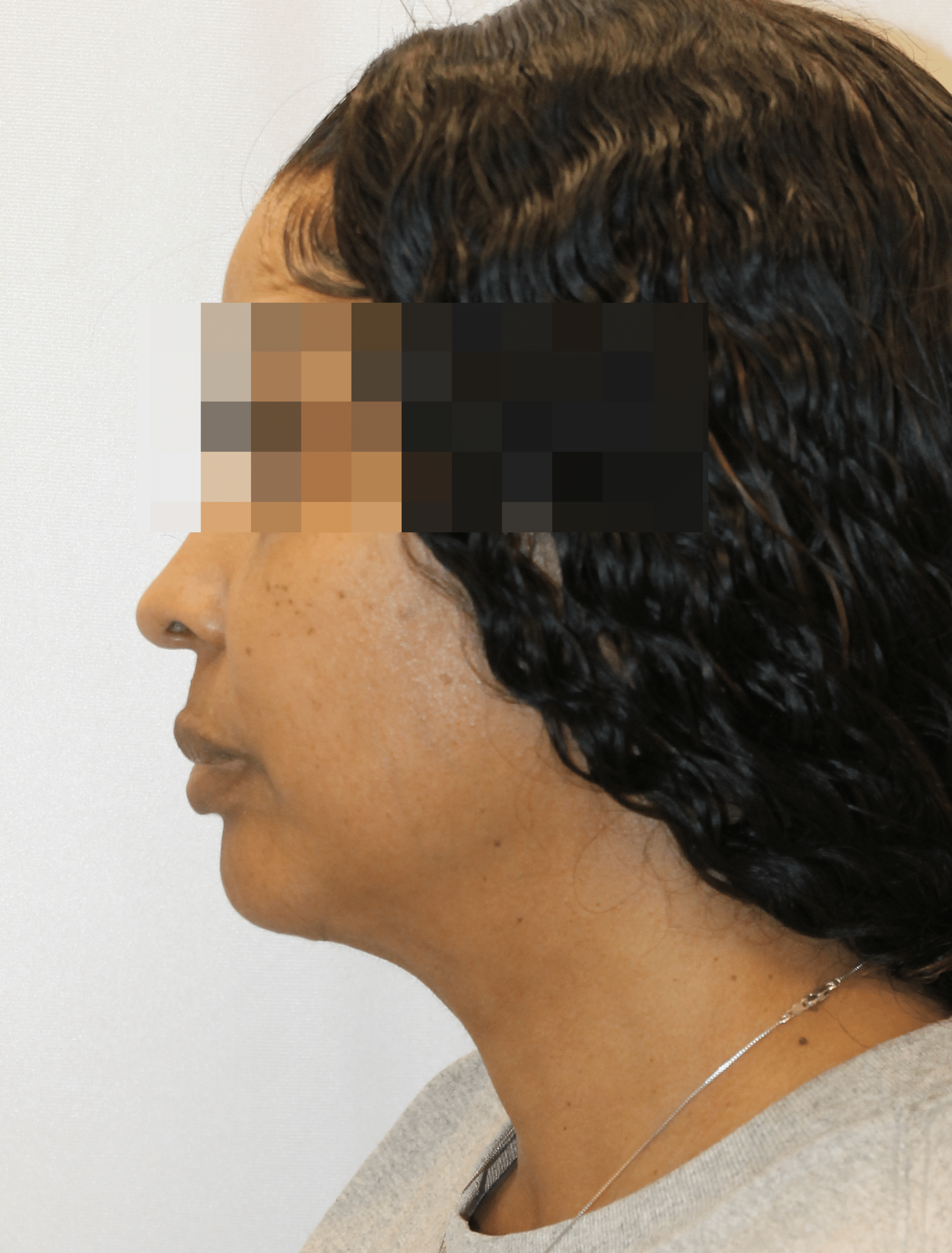 After Image:  - left-side
