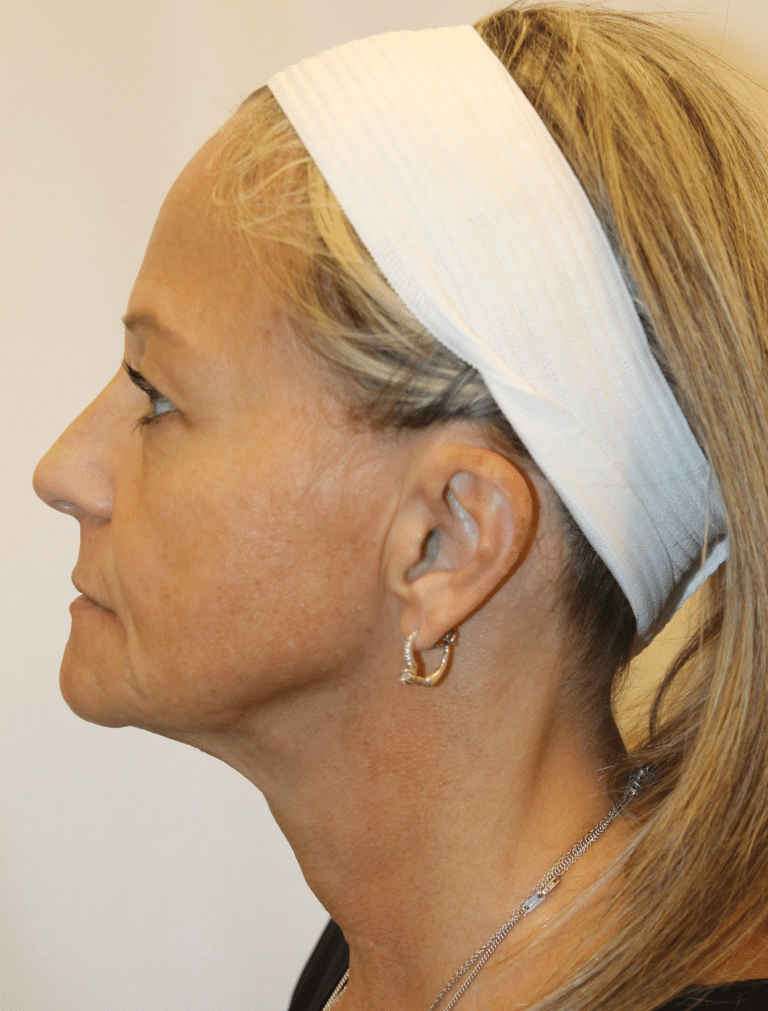 Before Image:  - left-side
