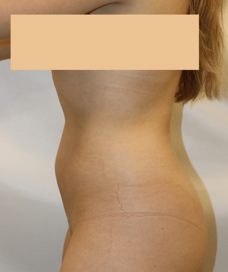 Before Image:  - left-side