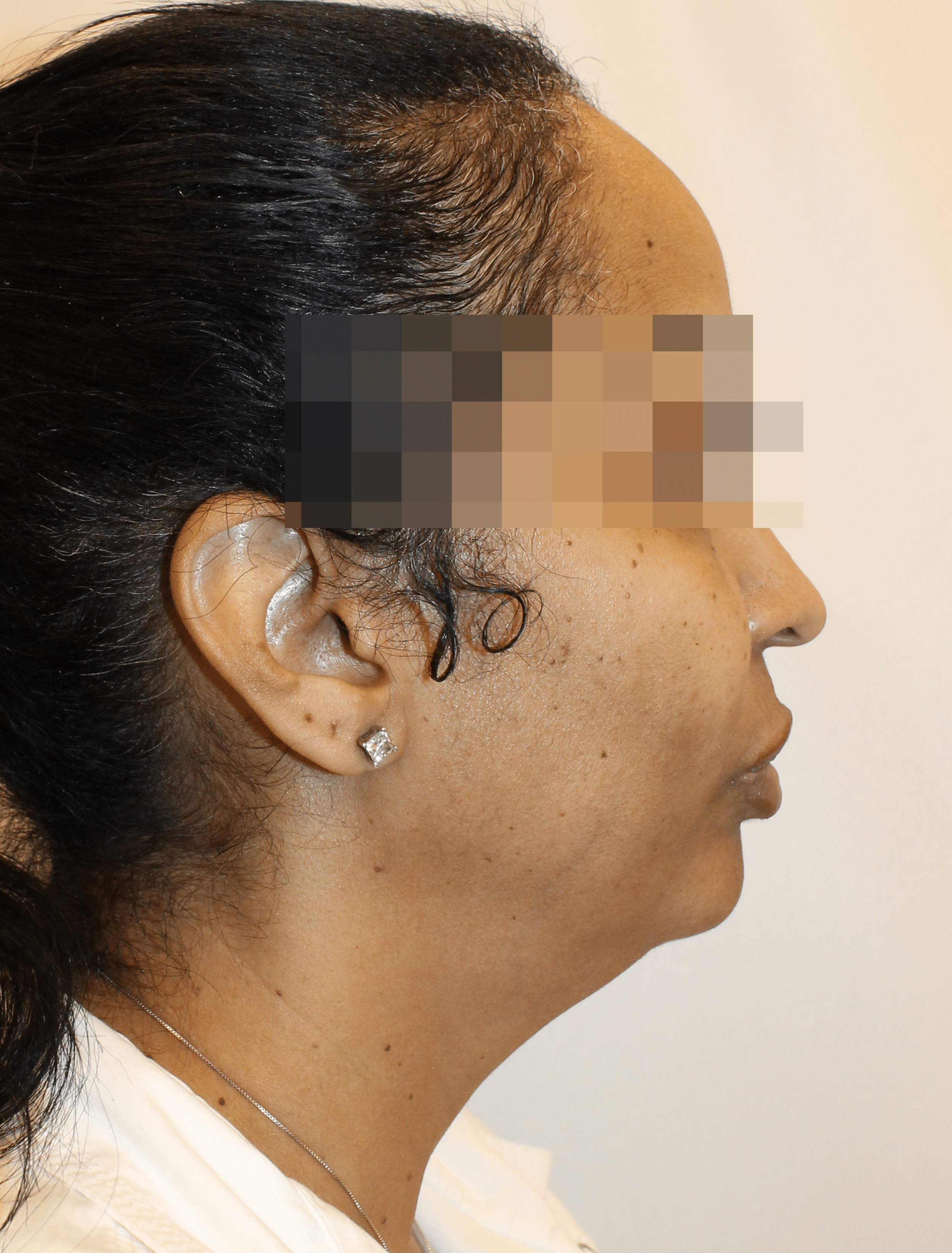 Before Image:  - right-side