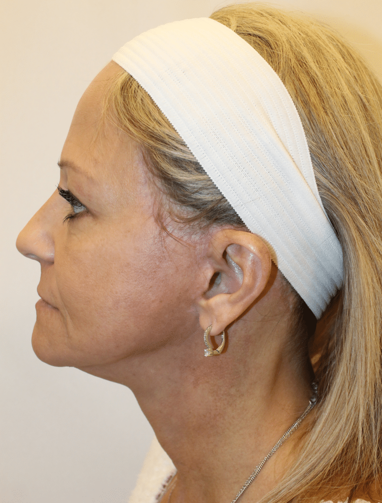 After Image:  - left-side