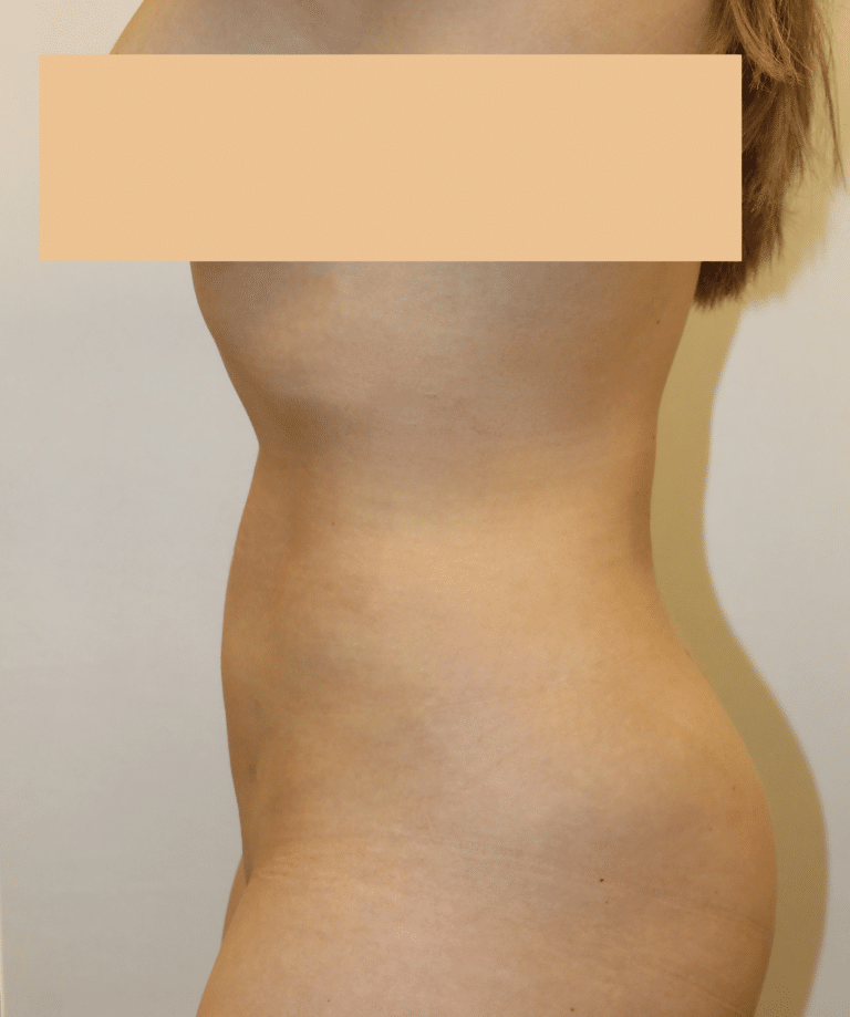 After Image:  - left-side