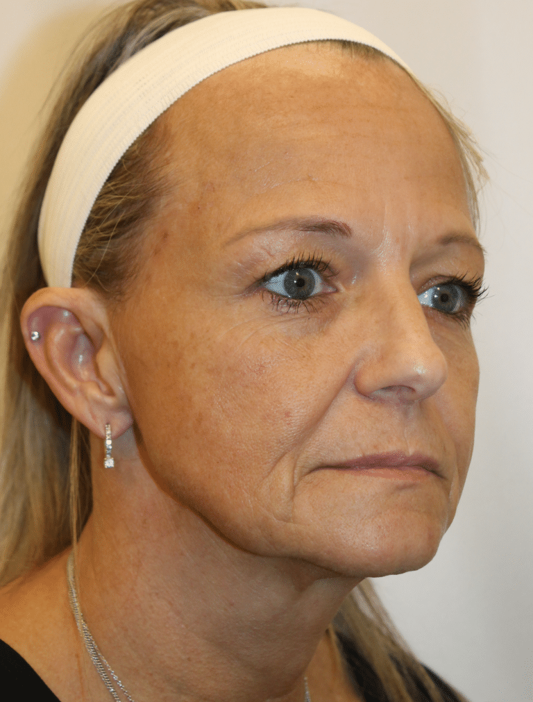 Before Image:  - right-front-oblique