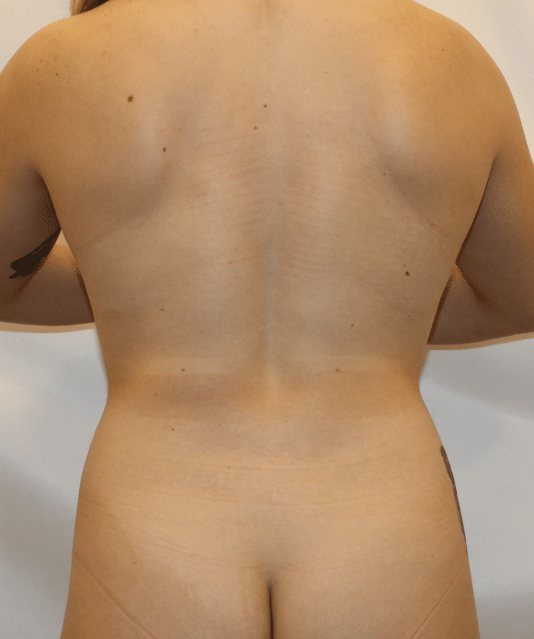 Before Image:  - back