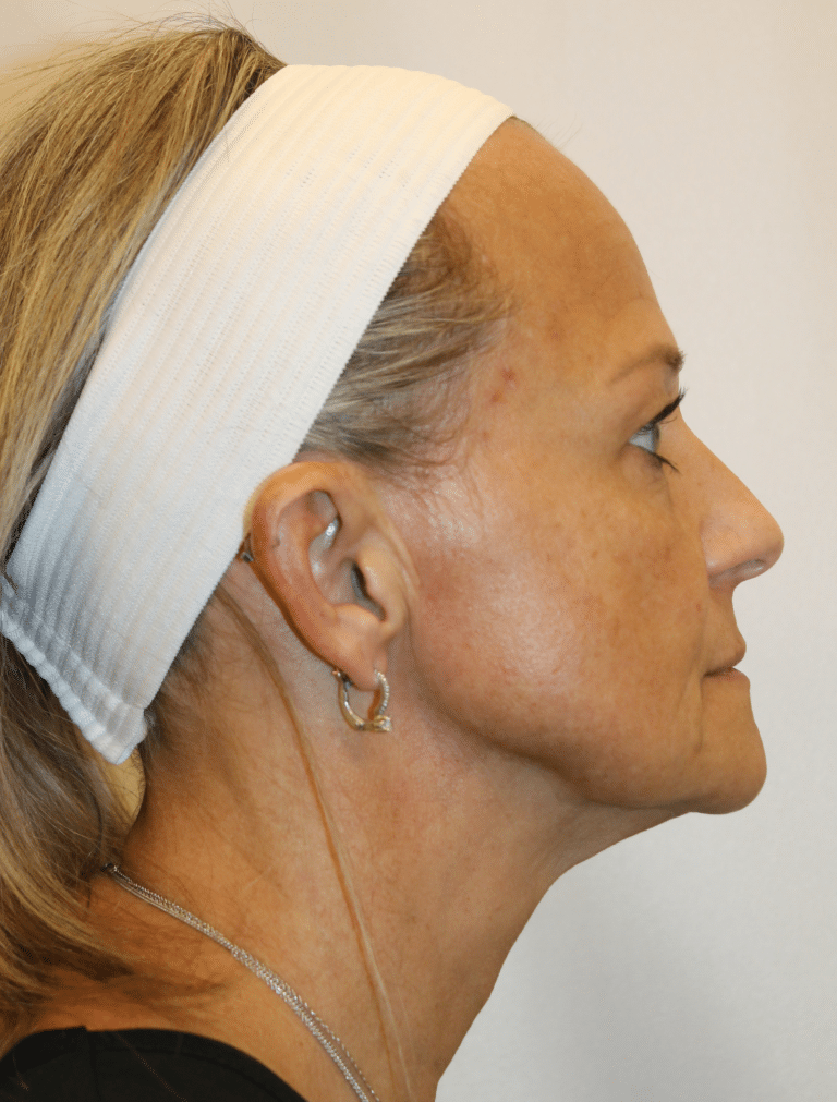 Before Image:  - right-side