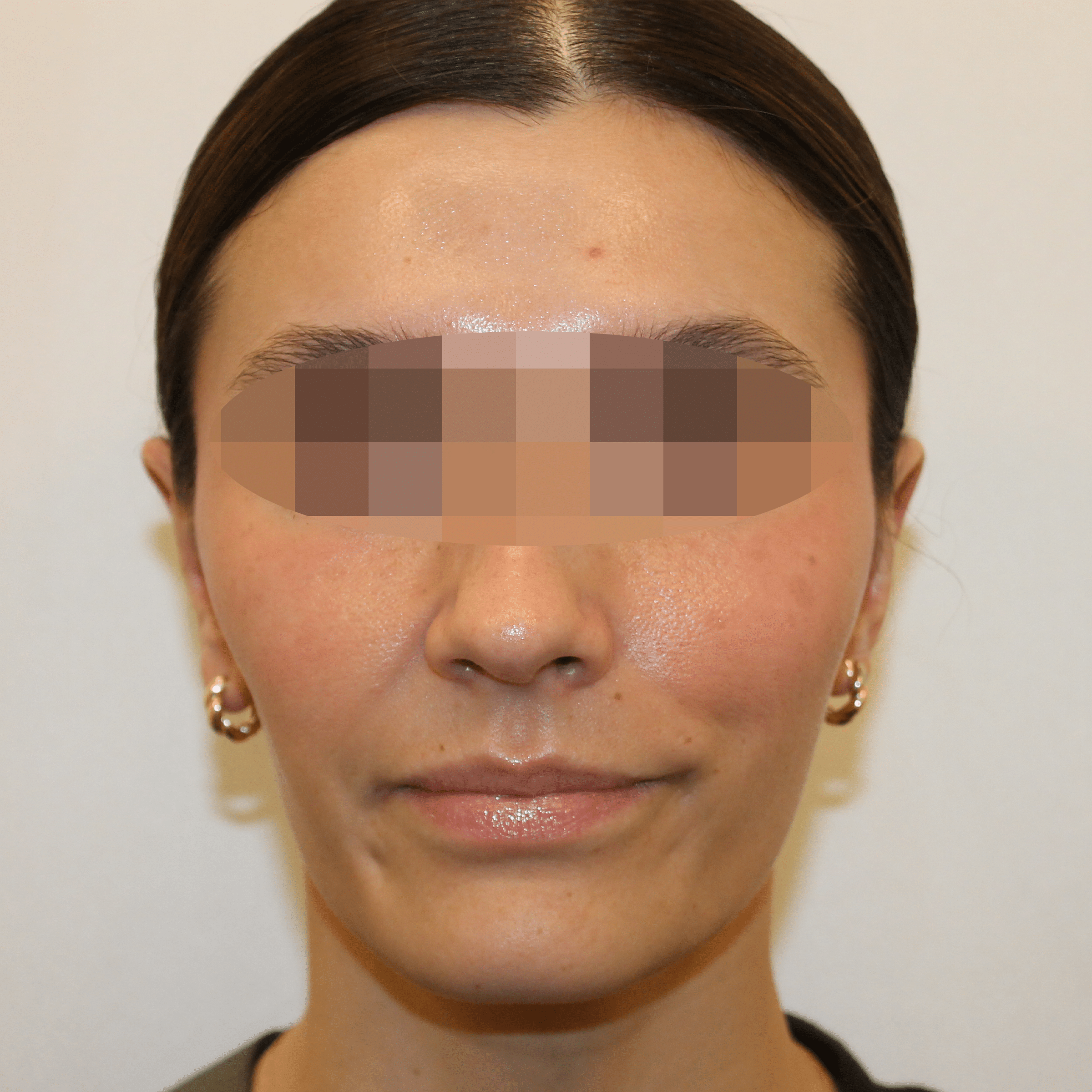 After Image:  - front