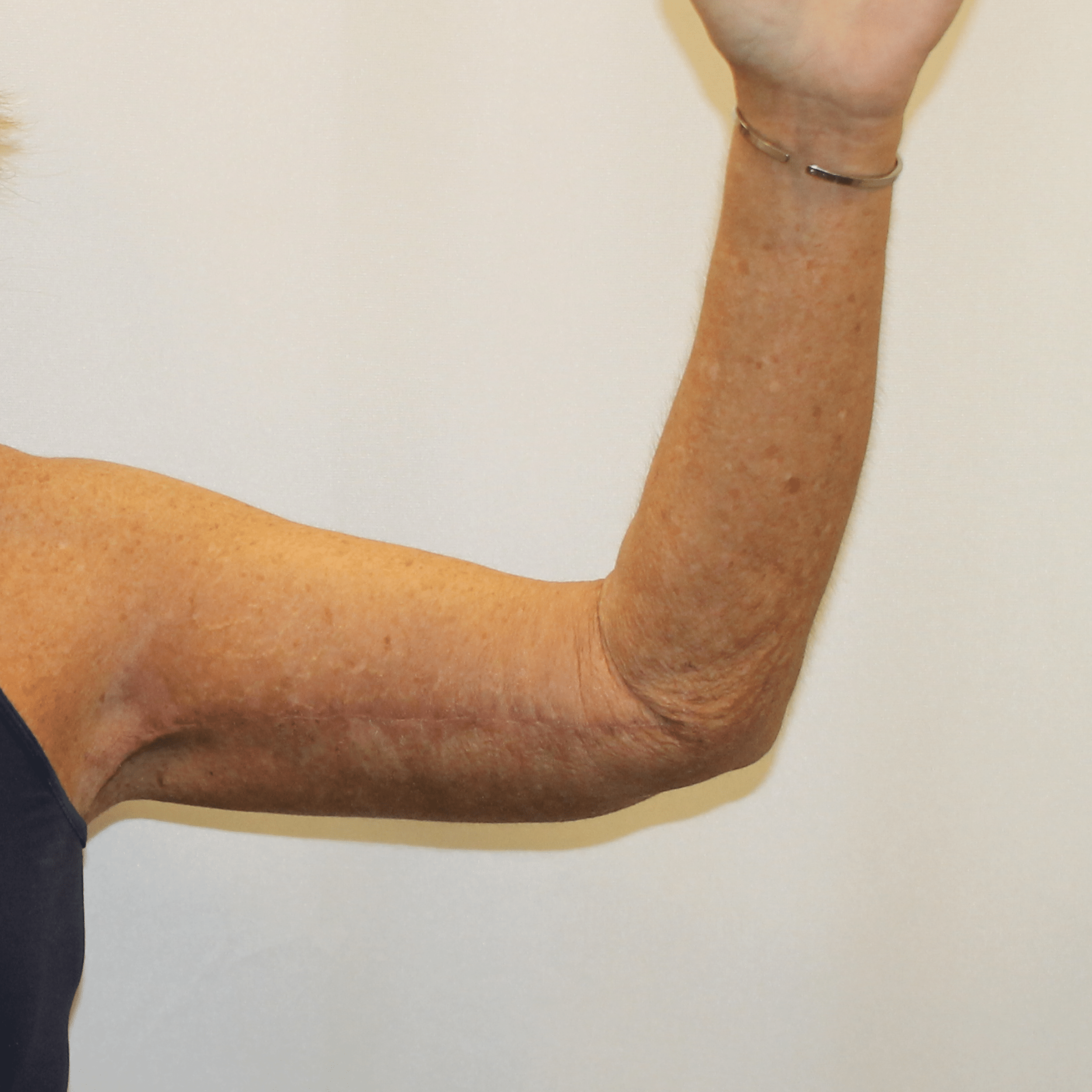 After Image:  - front