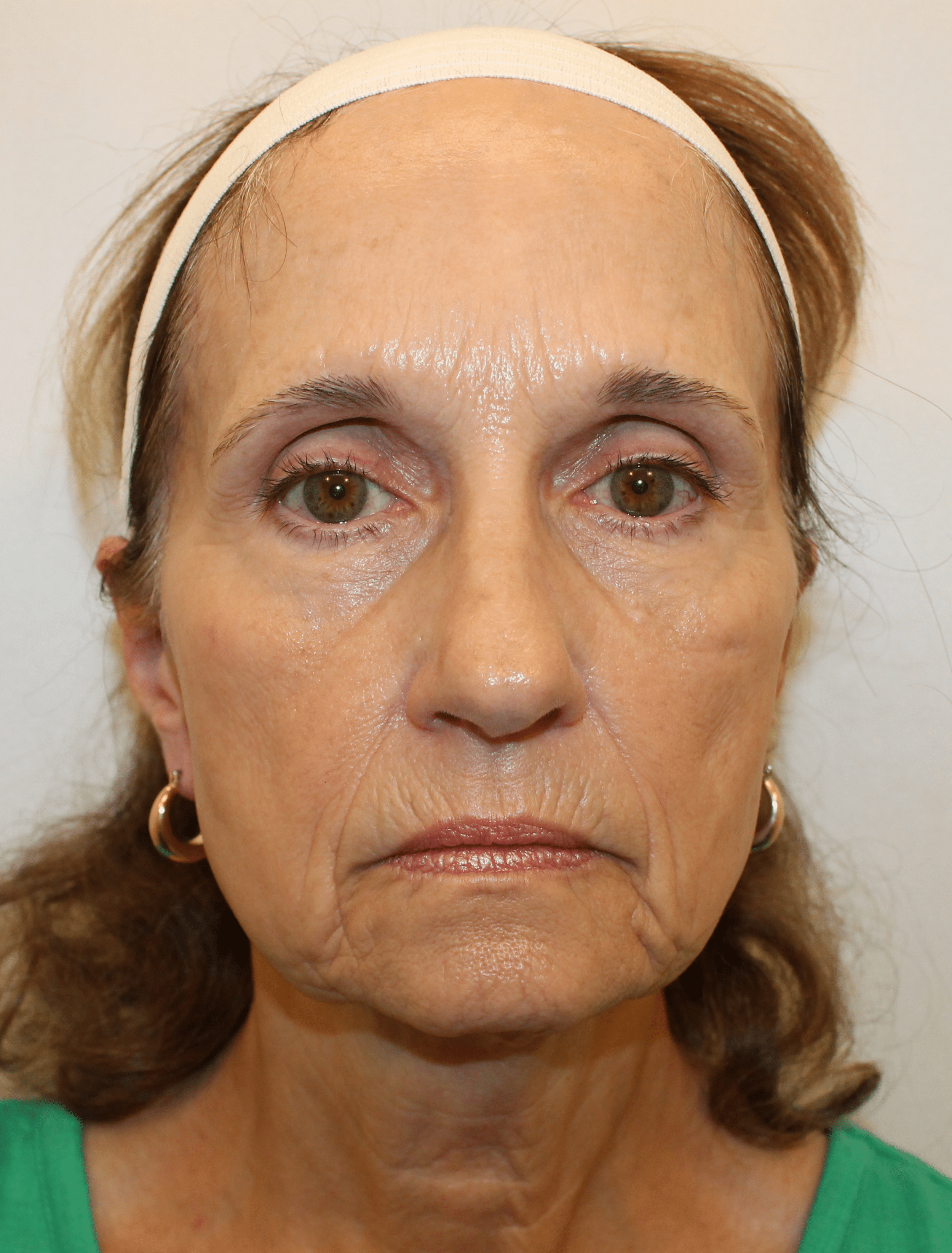 Before Image:  - front