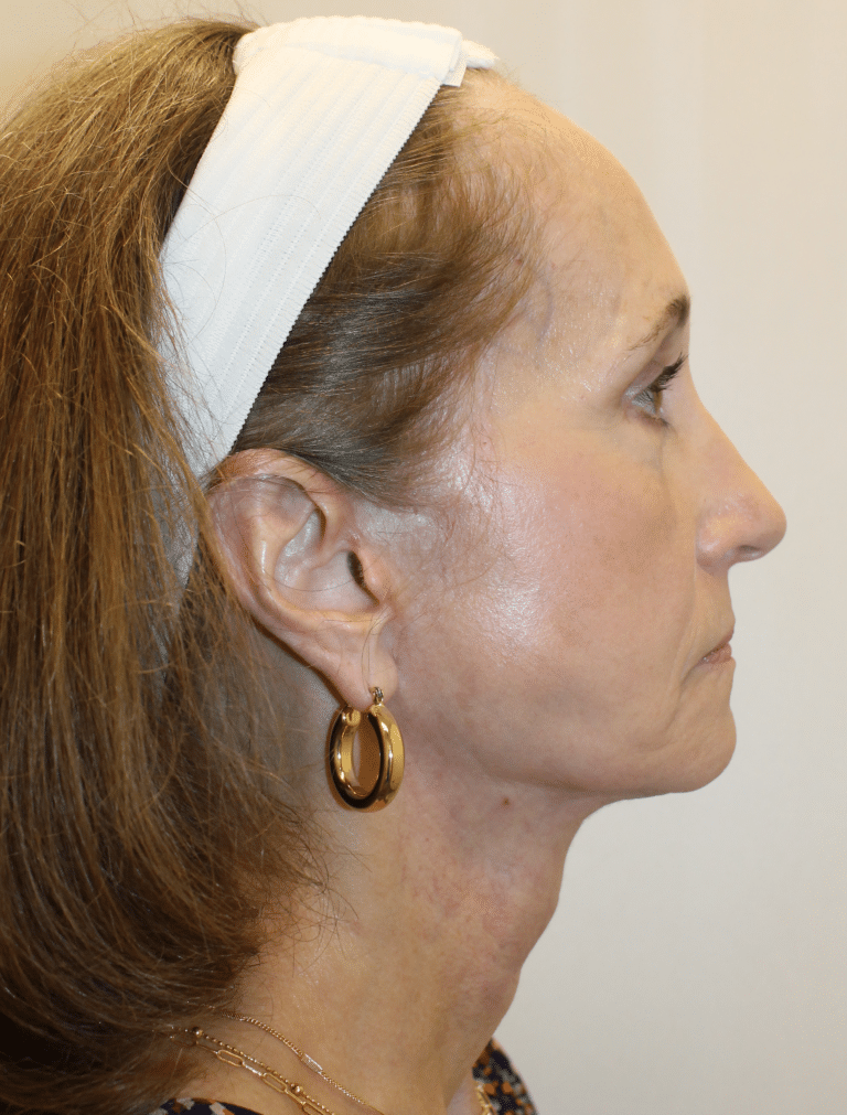 After Image:  - right-side