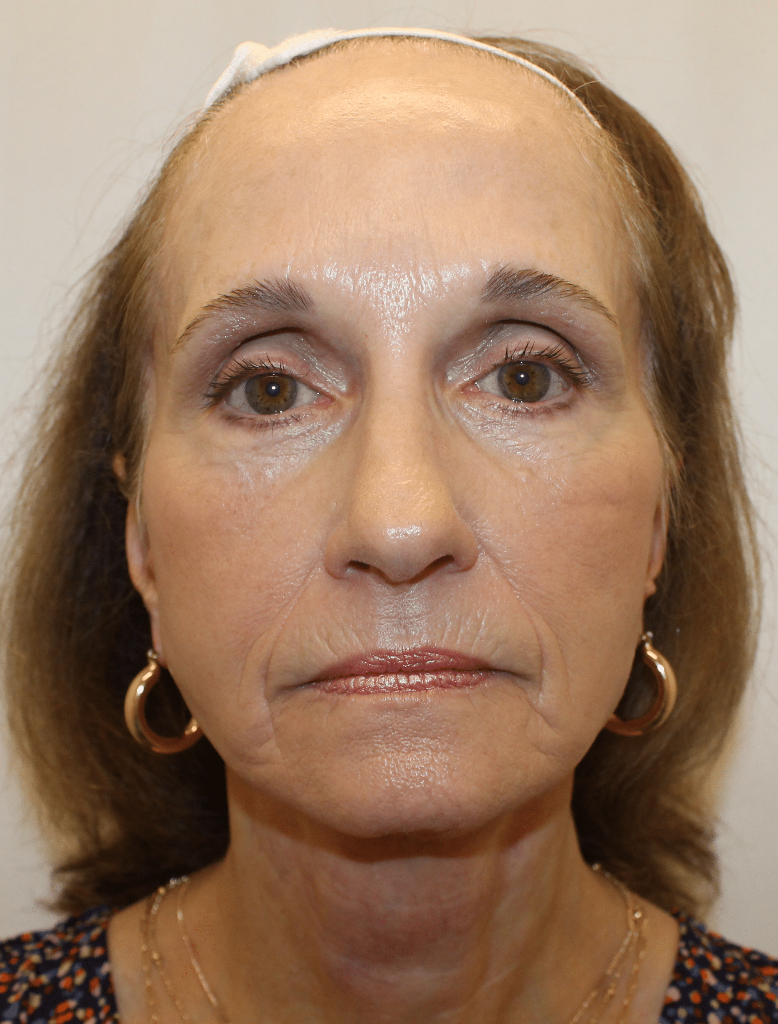 After Image:  - front